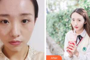 深圳民生婦科醫(yī)院整形美容中心張偉彬整形價格表附鼻部手術案例展示