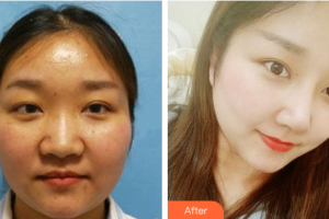 深圳博愛醫(yī)院整形美容中心許國明整形價格表附鼻部手術案例展示