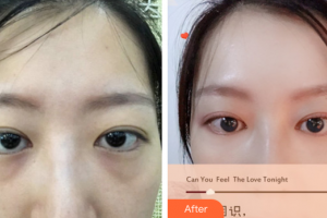 深圳瑞芙臣醫(yī)療美容門診部劉丹虹整形價格表附內路去眼袋案例展示