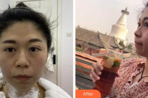 寧波藝星整形美容醫(yī)院李欣言整形價格表附熱瑪吉案例展示