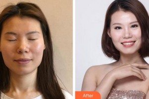 溫州藝星醫(yī)學(xué)美容醫(yī)院李春新整形價格表附眼部整形案例展示