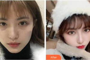 溫州藝星醫(yī)學(xué)美容醫(yī)院周聰鐸整形價格表附熱瑪吉案例展示