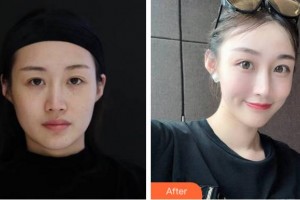 溫州藝星醫(yī)學(xué)美容醫(yī)院李久恒整形價格表附埋線提升案例展示
