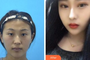 溫州藝星醫(yī)學(xué)美容醫(yī)院張至德整形價格表附切開雙眼皮案例展示