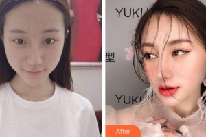 溫州藝星醫(yī)學(xué)美容醫(yī)院黃澤春整形價格表附眼部綜合案例展示