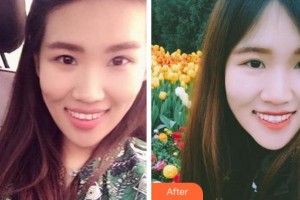 溫州王曉峰口腔醫(yī)院陳北云整形價(jià)格表附牙齒隱形矯正案例展示