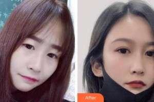 溫州明樂(lè)眼科醫(yī)院蔡迎暉整形價(jià)格表附切開雙眼皮案例展示