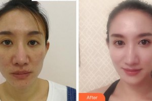 溫州明樂(lè)眼科醫(yī)院程鷺整形價(jià)格表附切開雙眼皮案例展示