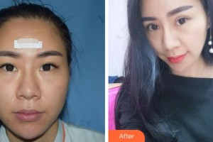 溫州明樂(lè)眼科醫(yī)院陳啟偉整形價(jià)格表附激光去眼袋案例展示