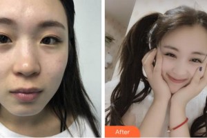 溫州明樂(lè)眼科醫(yī)院樸正勛整形價(jià)格表附眼部綜合案例展示