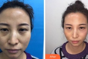 溫州明樂(lè)眼科醫(yī)院魏桂英整形價(jià)格表附眼部綜合案例展示