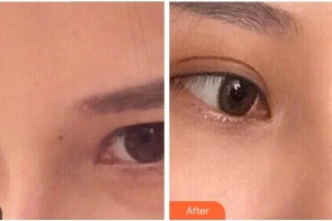 溫州明樂(lè)眼科醫(yī)院李連珠整形價(jià)格表附內(nèi)切祛眼袋案例展示