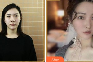 溫州醫(yī)科大學(xué)附屬眼視光醫(yī)院鄭斌整形價(jià)格表附眼部綜合案例展示