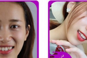 溫州拜博口腔醫(yī)院徐子卿整形價(jià)格表附牙齒隱形矯正案例展示
