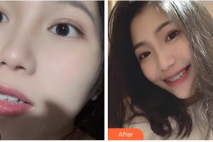 溫州華君美口腔門(mén)診部王光耀整形價(jià)格表附自鎖托槽矯正案例展示
