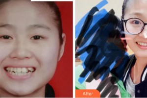 溫州藍(lán)芽口腔門(mén)診部趙微整形價(jià)格表附金屬托槽矯正案例展示