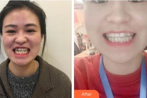 溫州牙博士口腔門(mén)診部魏謀達(dá)整形價(jià)格表附牙齒隱形矯正案例展示