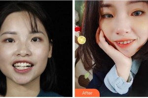 溫州牙博士口腔門(mén)診部呂昊昕整形價(jià)格表附金屬托槽矯正案例展示