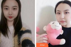 嘉興華山醫(yī)療美容醫(yī)院李紅波整形價(jià)格表附切開(kāi)雙眼皮案例展示