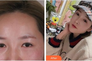 嘉興愛(ài)爾眼科醫(yī)院李文生整形價(jià)格表附眼部綜合案例展示
