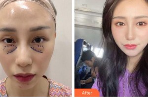 嘉興愛(ài)爾眼科醫(yī)院王春芳整形價(jià)格表附外切祛眼袋案例展示