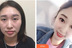 嘉興愛(ài)爾眼科醫(yī)院李光輝整形價(jià)格表附埋線雙眼皮案例展示