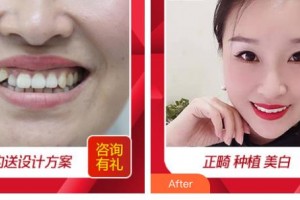 嘉興口腔醫(yī)院張國(guó)平整形價(jià)格表附隱形托槽矯正案例展示
