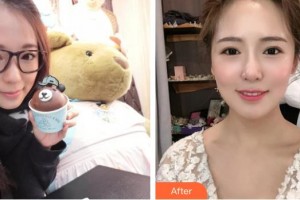 湖州潘震亞口腔診所潘震亞整形價(jià)格表附金屬托槽矯正案例展示