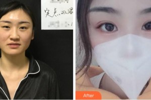 衢州芘麗芙整形美容醫(yī)院張小兵整形價(jià)格表附定點(diǎn)雙眼皮案例展示
