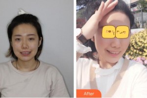 臺(tái)州維多利亞整形美容醫(yī)院藍(lán)?；壅蝺r(jià)格表附牙齒隱形矯正案例展示
