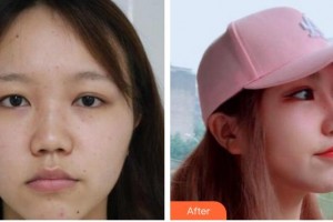 臺州昊陽醫(yī)療美容醫(yī)院王文波整形價格表附鼻部綜合案例展示