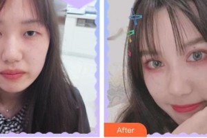 臺州國際眼科醫(yī)院黃小明整形價格表附開內眼角案例展示