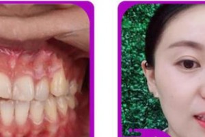 臺州牙博士口腔門診部黃翔宇整形價格表附牙齒隱形矯正案例展示