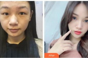 臺州國際眼科醫(yī)院鄭丹整形價格表附激光去眼袋案例展示