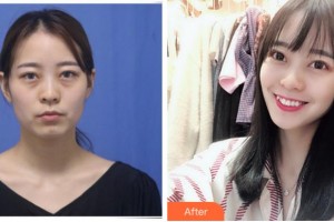 臺(tái)州國(guó)際眼科醫(yī)院鄭欽象整形價(jià)格表附激光去眼袋案例展示