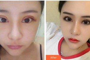 臺(tái)州國(guó)際眼科醫(yī)院余煥云整形價(jià)格表附切開雙眼皮案例展示