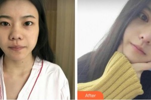臺(tái)州國(guó)際眼科醫(yī)院汪育文整形價(jià)格表附切開雙眼皮案例展示