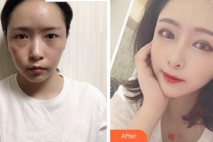 麗水慈愛醫(yī)院整形美容中心鄭承鎬整形價(jià)格表附眼部綜合案例展示
