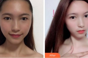麗水慈愛醫(yī)院整形美容中心李柄旭整形價(jià)格表附眼部綜合案例展示