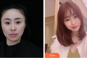 麗水思齊整形外科門診部蔣茂奇整形價(jià)格表附膠原蛋白除皺案例展示