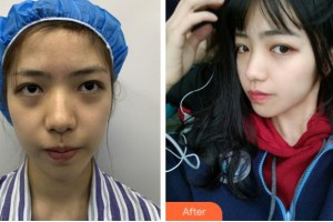 麗水思齊整形外科門診部BrianKinney整形價(jià)格表附埋線提升案例展示