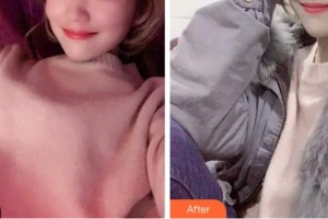 四川西嬋整形美容醫(yī)院孟家麟教授、整形價格表附超聲波潔牙案例展示
