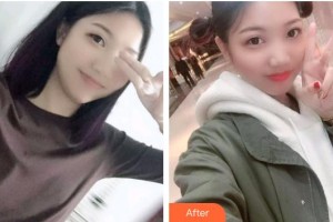 自貢維樂新橋口腔門診部田玉霞整形價格表附根管調(diào)節(jié)案例展示