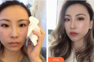 攀枝花大華醫(yī)學美容醫(yī)院劉永洪整形價格表附埋線提升案例展示