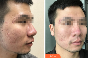 深圳博愛(ài)醫(yī)院整形美容中心楊昕整形價(jià)格表附清潔祛痘案例展示