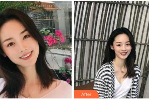 瀘州碧特牙科醫(yī)院雷光揚(yáng)整形價格表附金屬托槽矯正案例展示