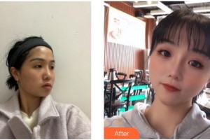 德陽金榮醫(yī)療美容?？漆t(yī)院吳沙冰整形價格表附埋線提升案例展示