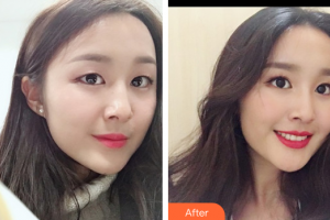 深圳美加美醫(yī)療美容門診部周國偉整形價(jià)格表附隆鼻案例展示