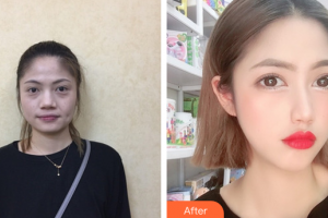 深圳格美醫(yī)療美容診所李英整形價(jià)格表附埋線(xiàn)提升案例展示