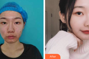 深圳美洛斯醫(yī)療美容診所張化博整形價(jià)格表附埋線(xiàn)雙眼皮案例展示